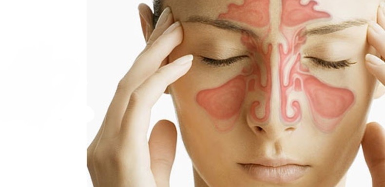 Metodos Naturales para Tratar la Sinusitis