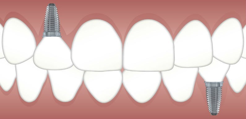 que es la implantologia dental