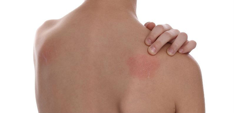 Manejar la dermatitis atopica