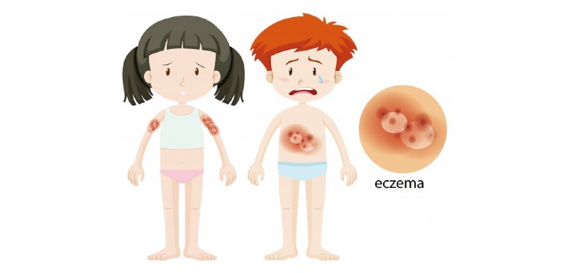 Dermatitis atópica